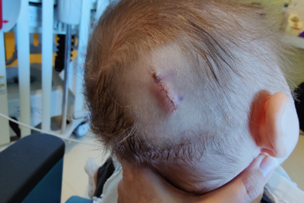 Ellia's surgical incision after brain cyst surgery