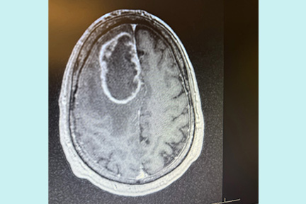 Scan of Scott’s brain showing a visible tumor, captured during diagnostic imaging.